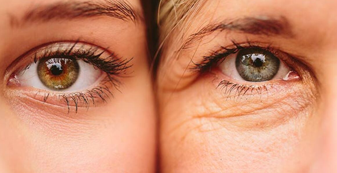 Signes externes de vieillissement de la peau autour des yeux chez deux femmes d'âges différents
