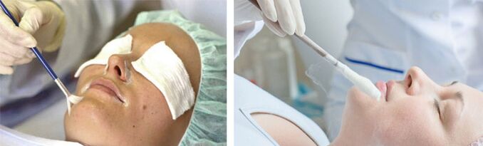 peeling et cryothérapie pour le rajeunissement de la peau