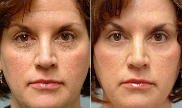 visage avant et après le rajeunissement fractionné au laser